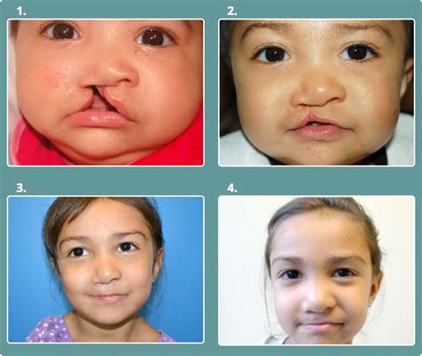 cleft lip and palate dating